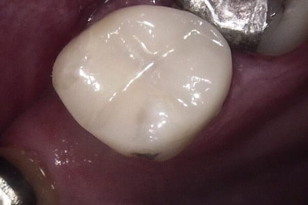 CrownComposite-After