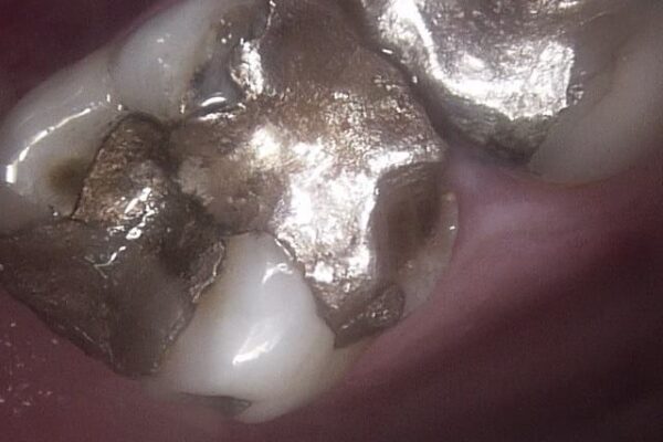 CrownComposite-Before