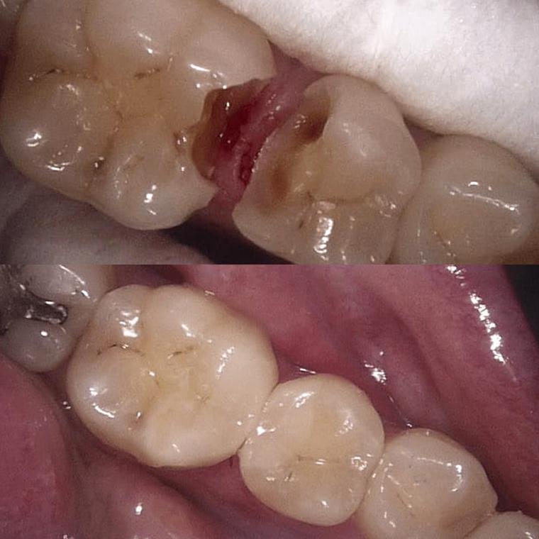 Fillings before and after