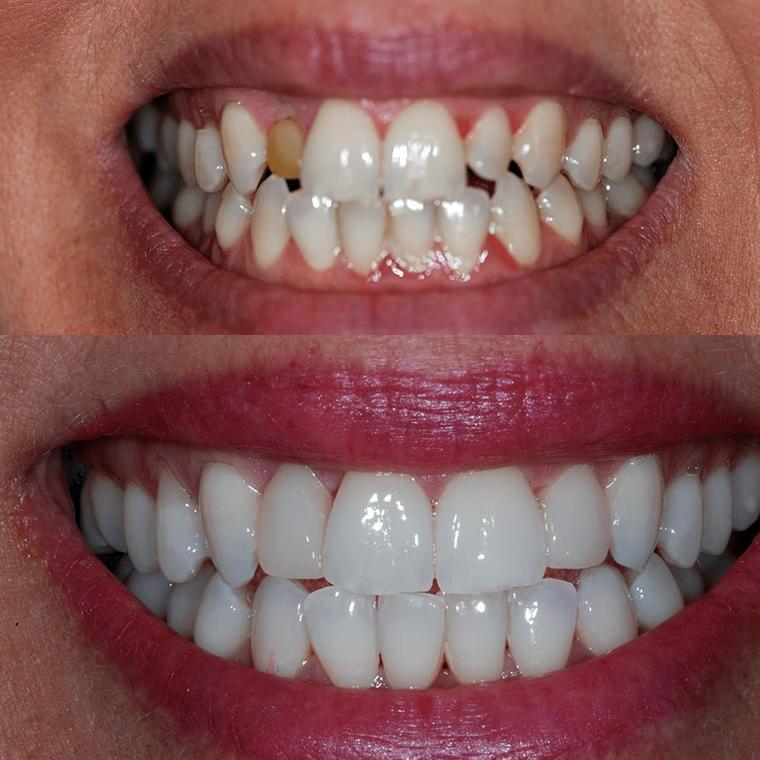 Teeth whitening before and after