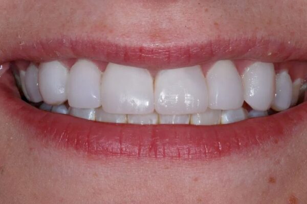 veneers-after-thorndon-dental