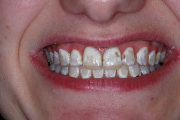 veneers-before-thorndon-dental