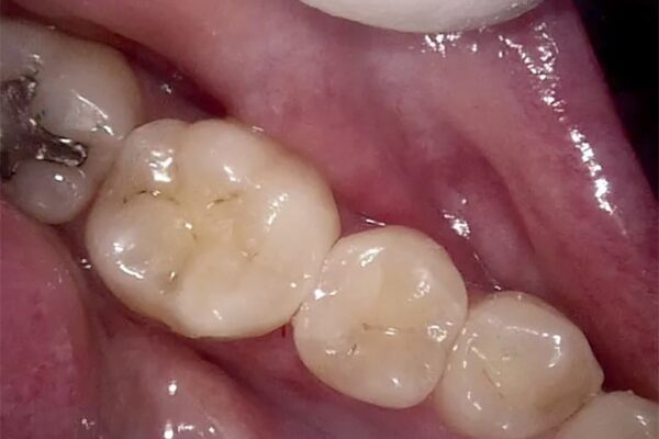 white-fillings-after-thorndon-dental