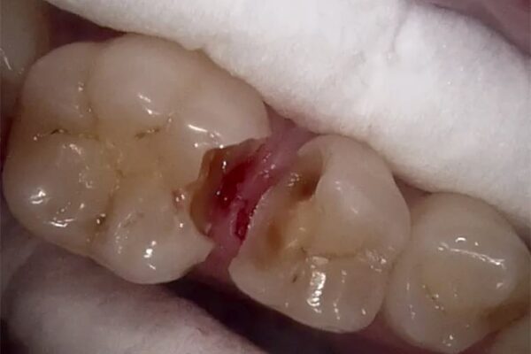 white-fillings-before-thorndon-dental